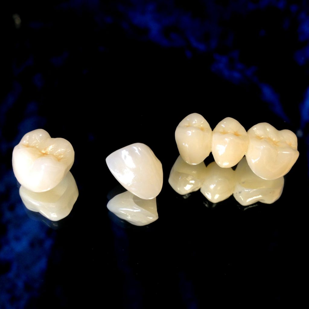 dental-crown-and-bridge