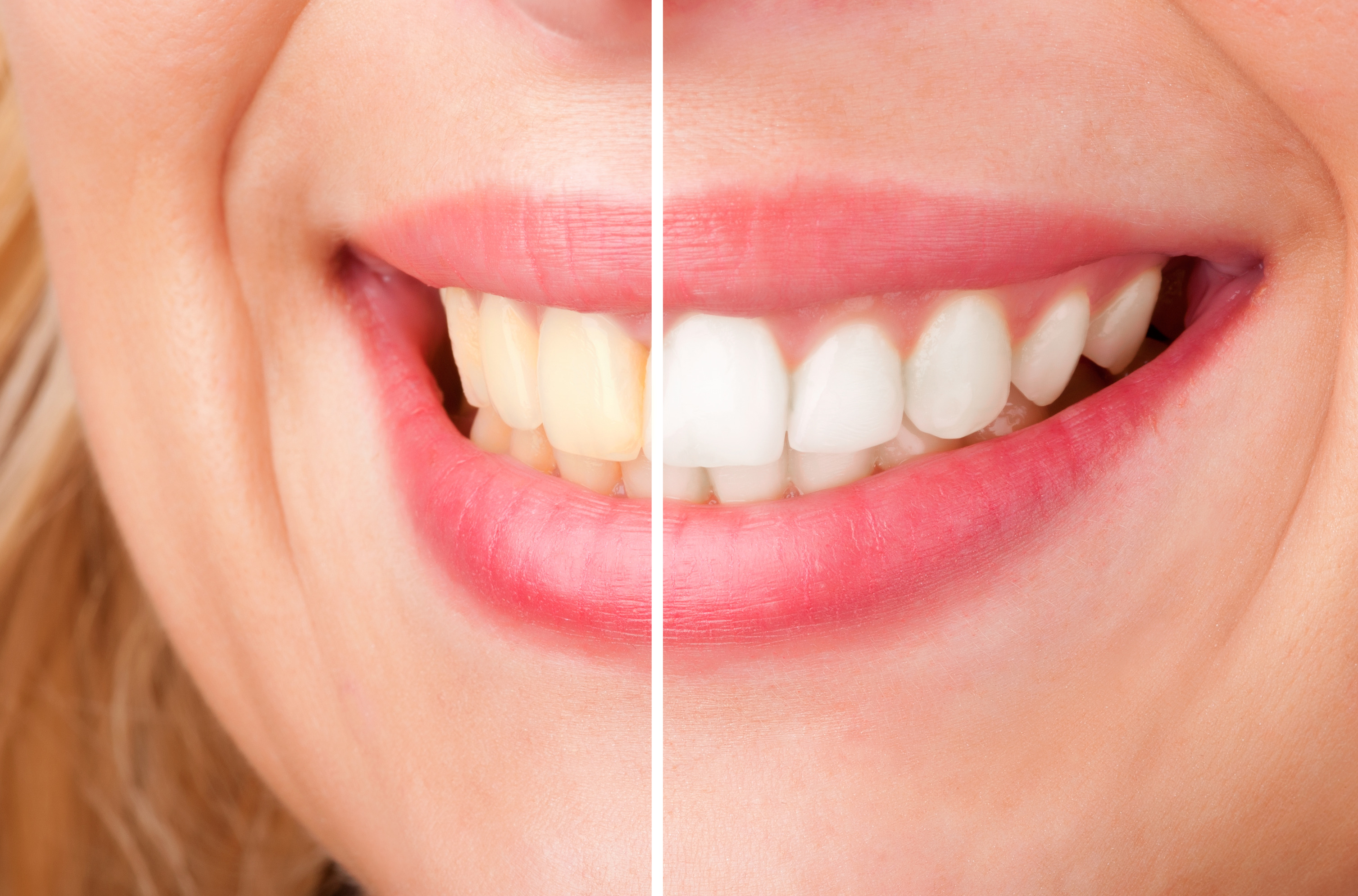 Before and after of a dental whitening procedure